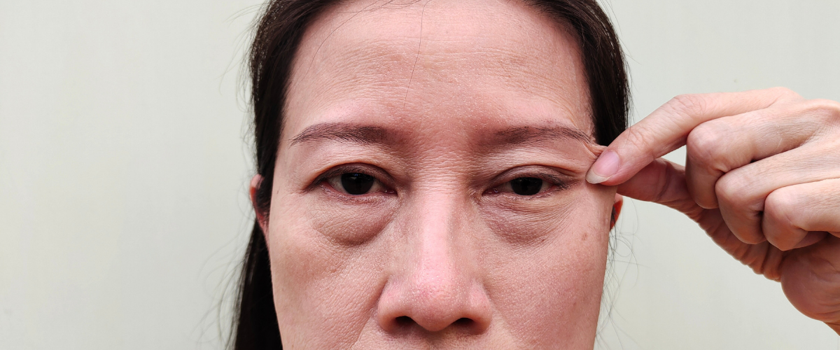 Göz Kapağı Estetiği Sonrası Gözlük ve Lens Kullanımı