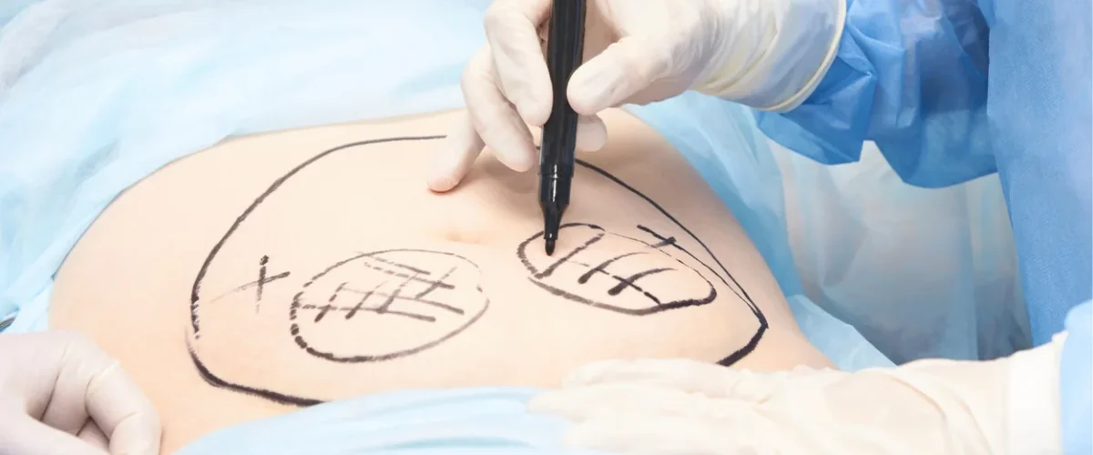liposuction-turleri-nelerdir liposuction-turleri-nelerdir